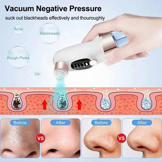 Nevytech blackhead remover vacuum provides deep pore cleansing, gentle suction, and clear skin resultsβideal for smooth, healthy-looking skin.