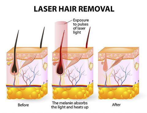 Illustration of laser hair removal process showing before and after effects on hair follicles.